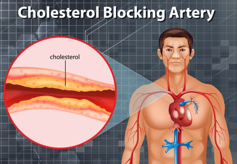 wie man cholesterin senkt